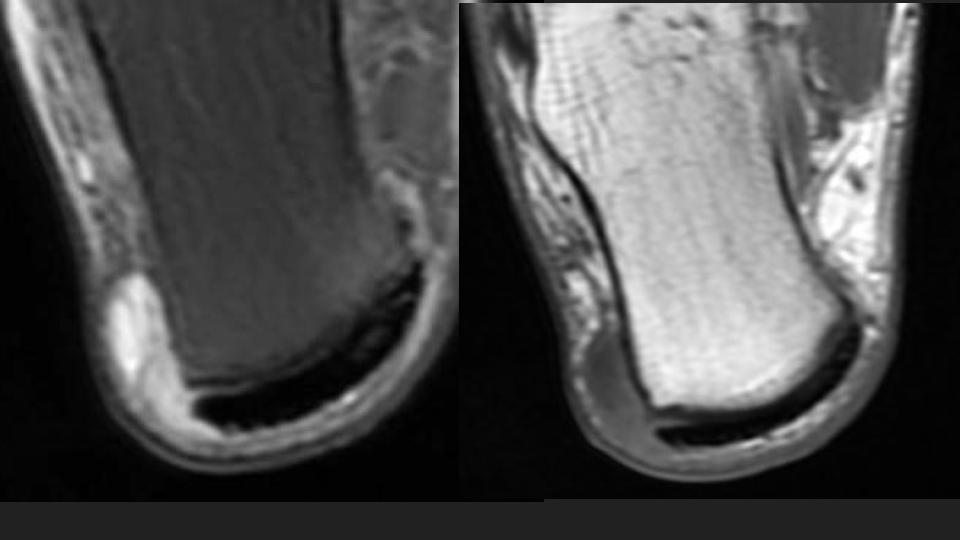 Figure 2 for case retrocalcaneal bursa ( RID3217 )